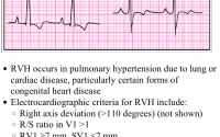 Pocket ECG